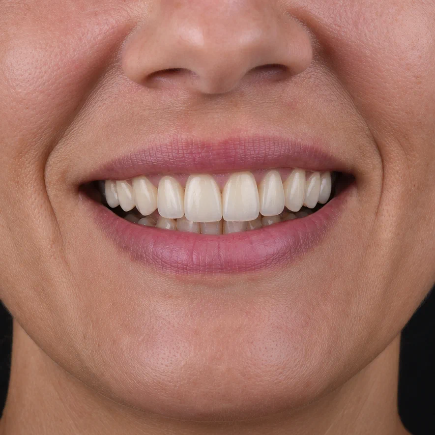 Veneers & Alignment after treatment