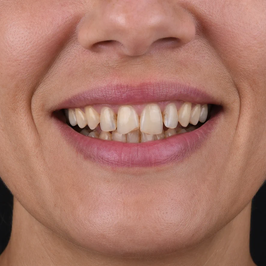 Veneers & Alignment before treatment
