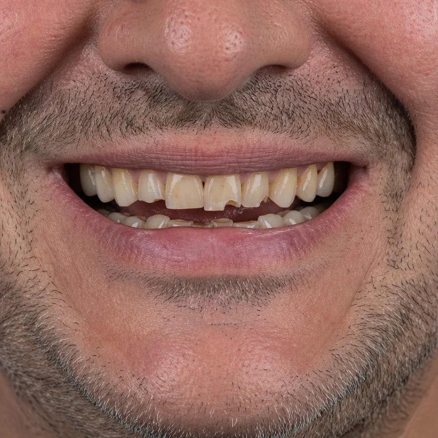 Restorative Smile Makeover before treatment