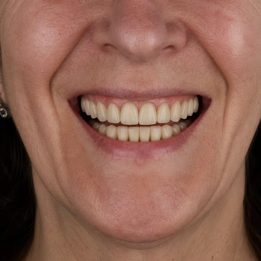 Full Mouth Rehabilitation after treatment