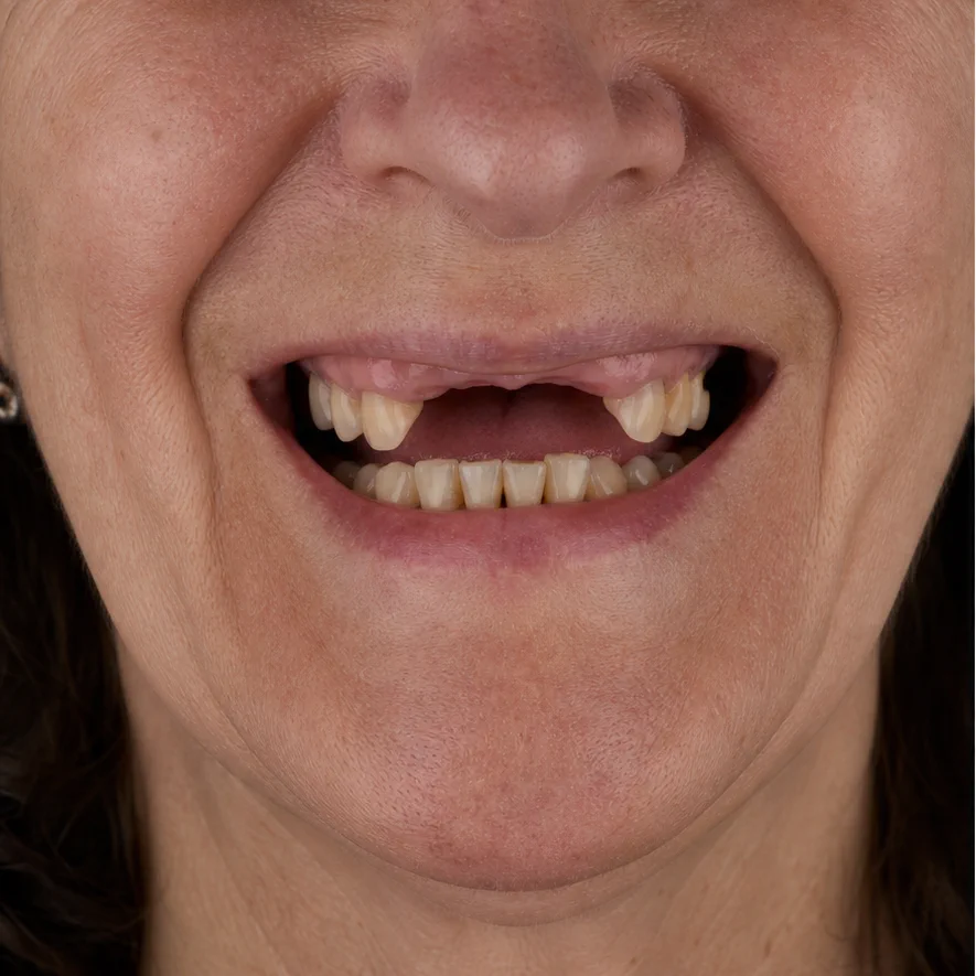 Full Mouth Rehabilitation before treatment
